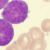 Scientists map the genetic evolution of a type of T-ALL